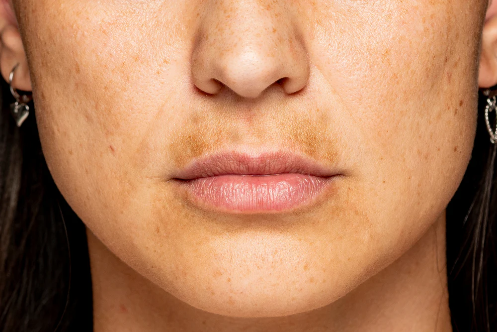 Uneven Skin Tone
