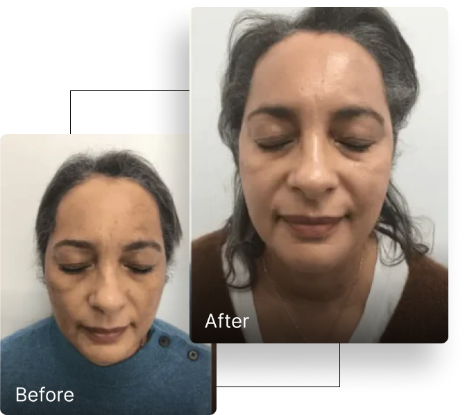 Before and after pigmentation treatment